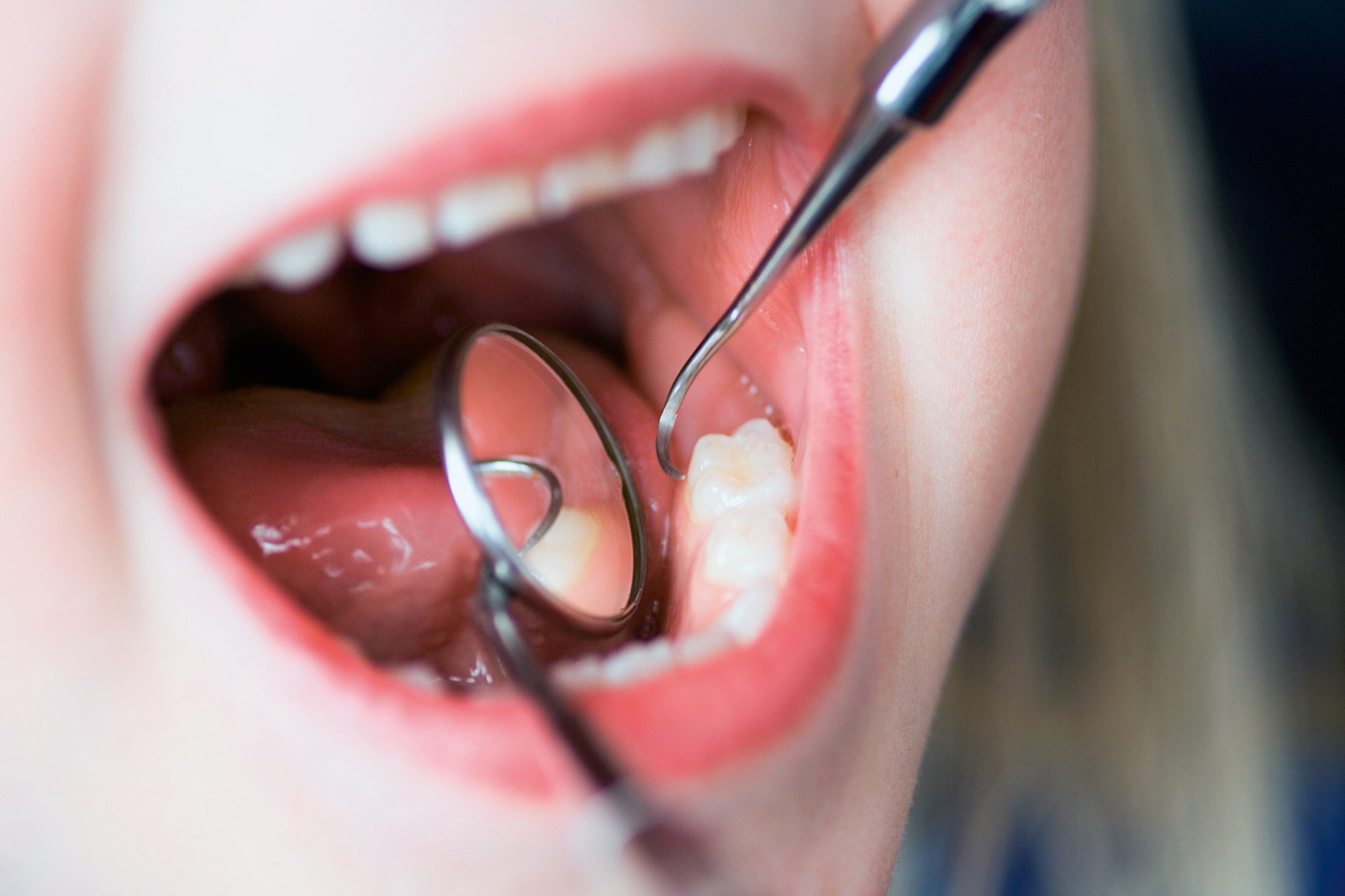 oral-cancer-pictures-diagnose