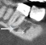 Figure 10: Localised areas of vascularity were observed in the mandibular right first and second molar region