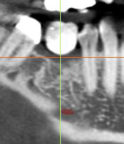 Figure 11: Mandibular right first molar region along the green line