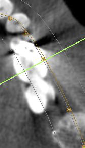 Figure 14: Mandibular left first molar region along the green line. The arrow indicates the superior edge of the area of increased vascularity previously described