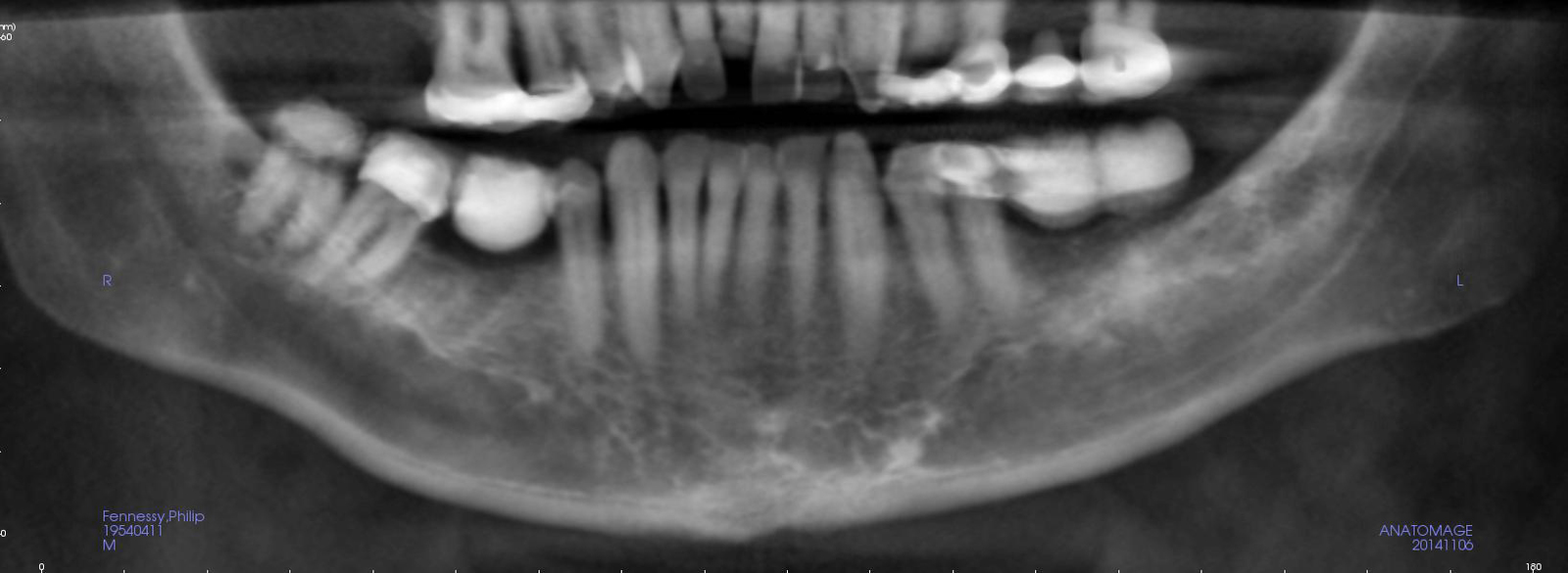 Figure 1: Reconstructed panoramic radiograph