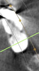 Figure 17: Mandibular left second molar region along the green line