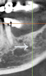 Figure 18: The arrow indicates the superior edge of the area of increased vascularity previously described