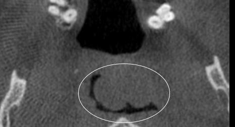 Figure 3: There appears to be an ovoid area of increased soft tissue density superior and posterior to the uvula and the soft palate. In addition, the pharyngeal tonsils appear to be enlarged