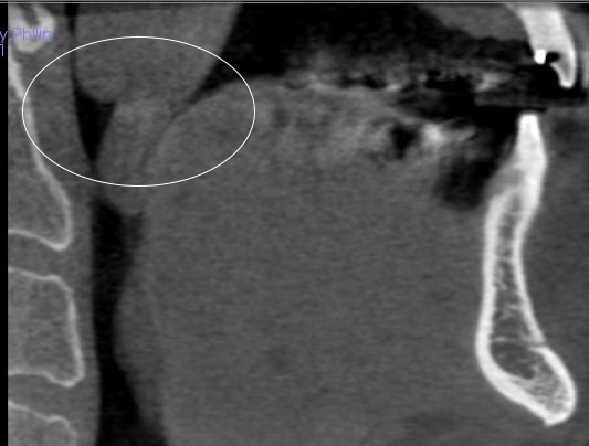 Figure 4: There appears to be an ovoid area of increased soft tissue density superior and posterior to the uvula and the soft palate. In addition, the pharyngeal tonsils appear to be enlarged