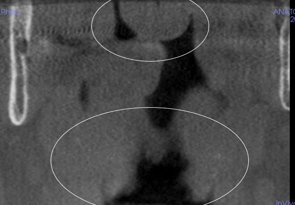 Figure 5: There appears to be an ovoid area of increased soft tissue density superior and posterior to the uvula and the soft palate. In addition, the pharyngeal tonsils appear to be enlarged