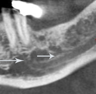 Figure 3: There appears to be an ovoid area of increased soft tissue density superior and posterior to the uvula and the soft palate. In addition, the pharyngeal tonsils appear to be enlarged