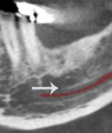 Figure 8: There appears to be a localised increase in vascularity in the mandibular left first molar region (arrows)