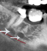 Figure 8: Localised areas of vascularity were observed in the mandibular right first and second molar region