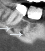 Figure 9: Localised areas of vascularity were observed in the mandibular right first and second molar region