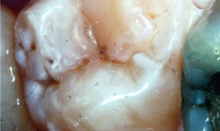 Figure 1b: Molar cavity restored with a nano filled aesthetic composite resin – Dr Nik Sethi