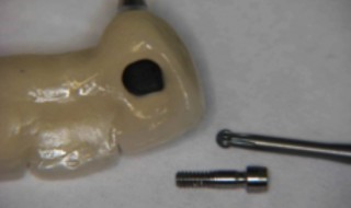 Figure 6: Cara screw retained bridge