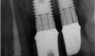 Figure 3: Radiograph of implants