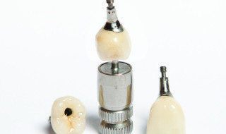 Screw-retained implants are now becoming the norm, simplifying the restoration aspect