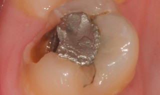 fractured buccal cusp