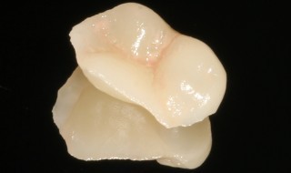 fractured buccal cusp