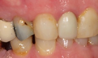 Pre-operative (left intra oral smile)