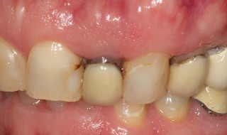 Pre-operative (right intra oral smile)