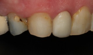 Pre-operative (left intra oral smile with contraster)
