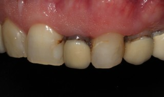 Pre-operative (right intra oral smile with contraster)