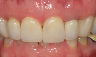 Post-operative (intra oral smile)