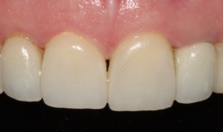 Post-operative (intra oral smile with contraster)