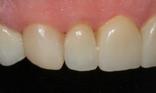 Post-operative (right intra oral smile with contraster)