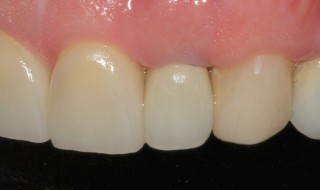 Post-operative (left intra oral smile with contraster)