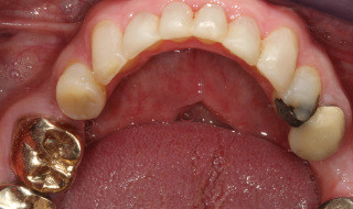 Post-operative (lower arch)