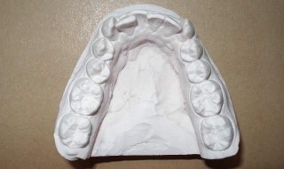 Figure 4: Occlusal view of mandibular anterior crowding