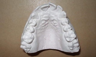 Figure 3: Occlusal view of maxillary anterior crowding 