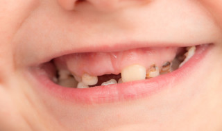 child tooth decay