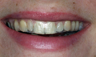 Whitestrips in place