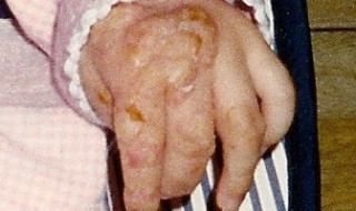 Figure 1: Skin lesions of IP