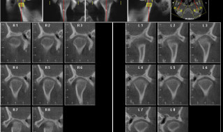 Figure 5: CBCT to check joints and 3D planning