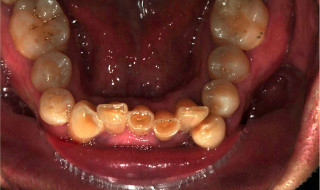 Figure 4: Lower occlusal view pre-treatment