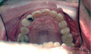 Figure 7: Upper occlusal view post-alignment
