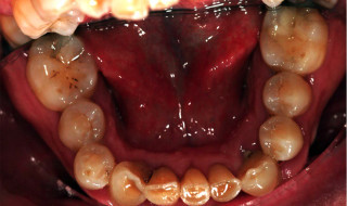 Figure 8: Lower occlusal view post-alignment