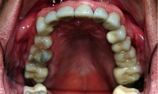 Figure 11: Upper occlusal view following crown placement