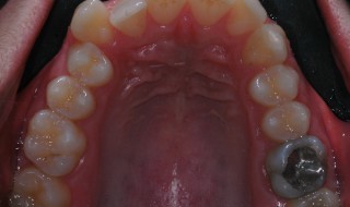 Figure 1: Upper arch before treatment