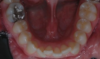 Figure 2: Lower arch before treatment