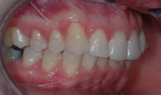 Figure 9: Right buccal occlusion after alignment