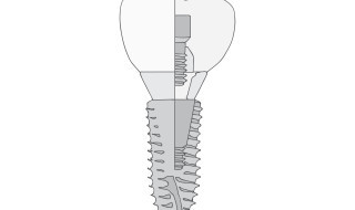 Vector-Implant