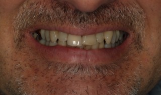 Figure 1: Patient with an UR1 central incisor presenting with trauma and supra-eruption