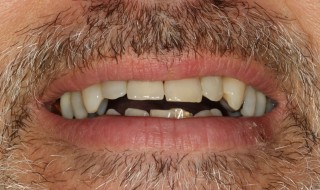 Figure 2: UR1 central incisor extracted and restored with a new implant-supported crown restoration
