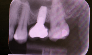 Figure 3: UL6 missing molar restored with an implant crown prosthesis after an internal sinus elevation procedure