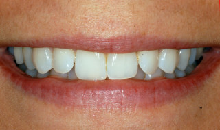 Figure 1a: The patient has a wide smile