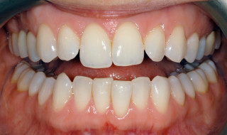Figure 1b: Incisal symmetry is upset by the crowding of the anterior teeth