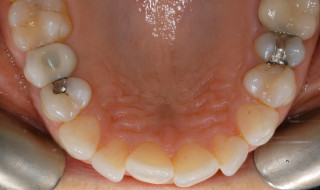 Figure 1c: The anterior malocclusion of lower teeth are suitable for repositioning with cosmetically-focused adult orthodontics