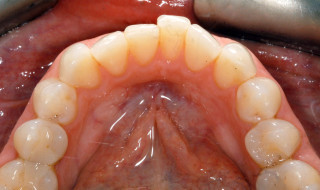 Figure 1d: The anterior malocclusion of upper teeth are suitable for repositioning with cosmetically-focused adult orthodontics